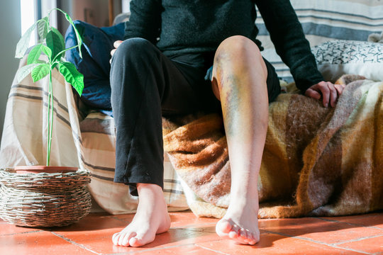 woman with a large hematoma on her leg