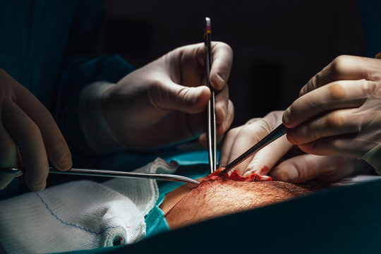 Team Of Surgeons Operating a Man Nipple In The Hospital