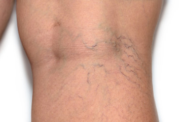 Close up varicose spider vein on skin crook leg elderly woman, Problem thrombosis that can cause...