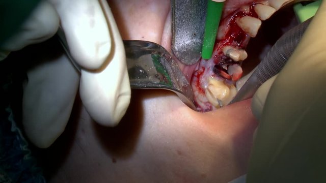 Close up stomatologist extract tooth in operating room dental clinic. Dental Implant Surgery.