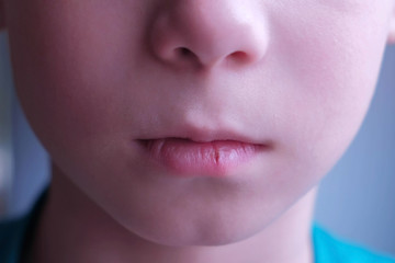 Little cracked cut on boy's lip. Child boy with herpes sore on the lip, mouth closeup. Process of dehydration during illness.