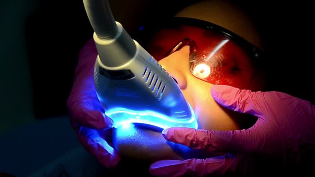 Young woman with an expander in mouth and red protective glasses getting UV whitening at the dentist's office by an ultra violet machine.