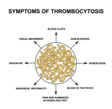 Symptoms of thrombocytosis. An increase in platelets in the blood. Infographics. Vector illustration on isolated background.