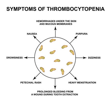 Symptoms of thrombocytopenia. Reducing platelets in the blood. Infographics. Vector illustration on isolated background.
