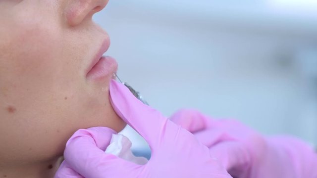 Cosmetologist doctor making injection in woman lips to volume and correction shape lips closeup, side view. Beautician injects filler collagen or hyaluronic acid into lips. Contour Plastic of Lips.