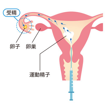 人工授精　不妊治療
