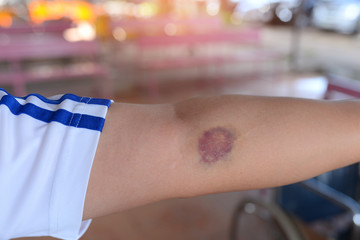 Contusion wound at left arm wiht the background of the wheelchair's blur. Broken capillaries.
