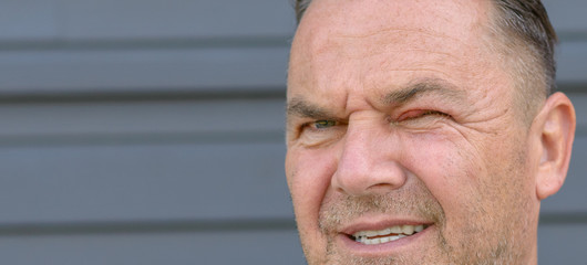 Man with swollen red eye and conjunctivitis