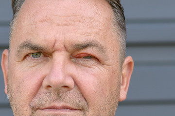 Middle-aged man with a stye or hordeolum