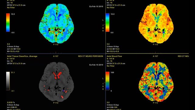 CT Brain Perfusion or CT scan image of the brain 3d rendering image analyzing cerebral blood flow on the monitor.