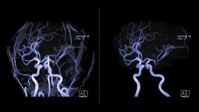 MRA Brain or Magnetic resonance angiography (MRA) of Vessel in the brain turn around on the screen. MRA Brain MIP view for evaluate cerebral artery.