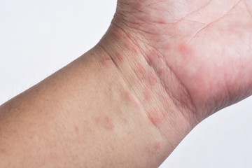 Red allergic rash from Atopic dermatitis on the wrist .