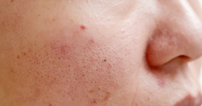 acne on the woman face