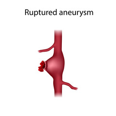 Ruptured aneurysm. Bleeding, vessel. Medical anatomy illustration.