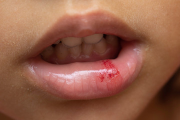 Close up of bloody lip of a girl