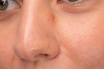 Pimple purulent on woman's nose