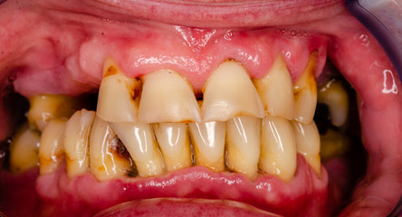akute parodontitis mit tiefen zahnfleischläsionen