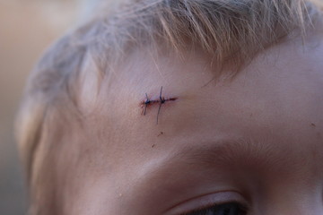 cicatrice b&eacute;b&eacute; point de suture