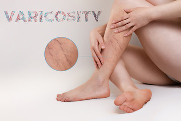 The concept of varicose disease and medicine. The woman sits with her slender legs crossed and her arms around them. Enlarged image of the affected vessels. Text VARICOSITY