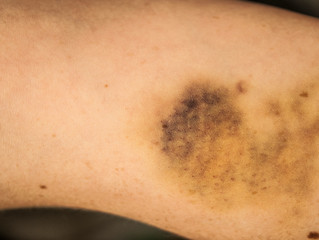 Fototapeta premium large hematoma on human arm