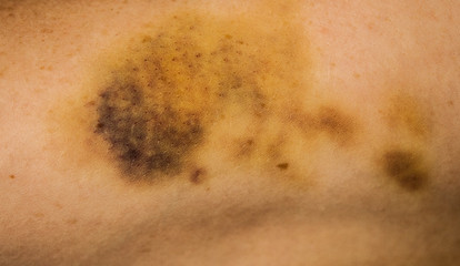 Fototapeta premium large hematoma on human arm