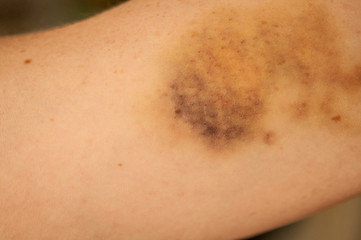 large hematoma on human arm