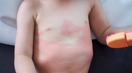 Severe eczema skin rash and allergic reaction symtom at little asian child body cause by...