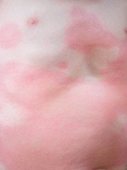Obraz na płótnie Canvas Severe eczema skin rash and allergic reaction symtom at little asian child body cause by hypersensitivity