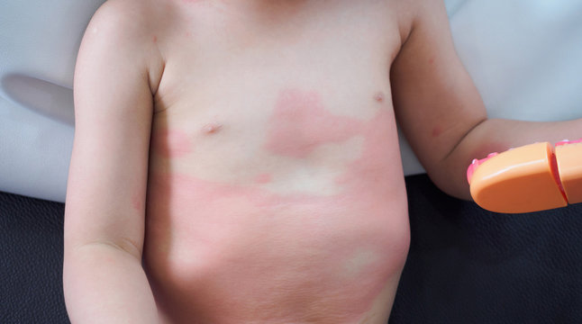 Severe eczema skin rash and allergic reaction symtom at little asian child body cause by hypersensitivity