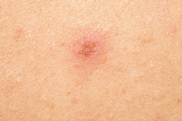 Crust on skin close up