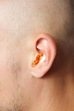 Close up view of a young man with bloody cotton wool in his ear. Concept of ear infections, bleeding and ear pain