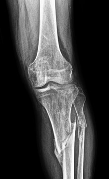 x-ray of fracture of the bones of the leg