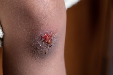 Scratched knee and bruise close up with red blood and serosanguinous fluid drops