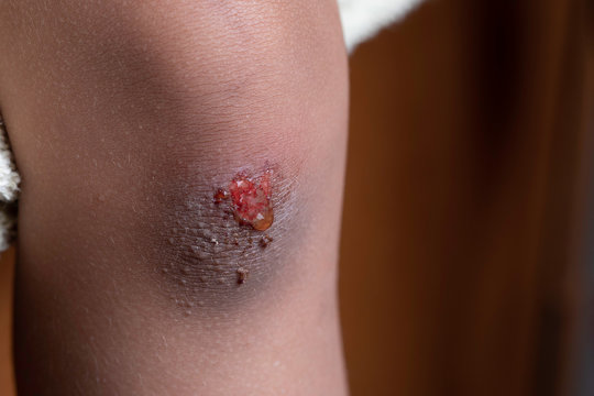 Scratched knee and bruise close up with red blood and serosanguinous fluid drops