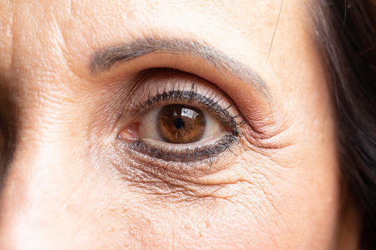 Female ageing skin with numerous crows feet wrinkles close up
