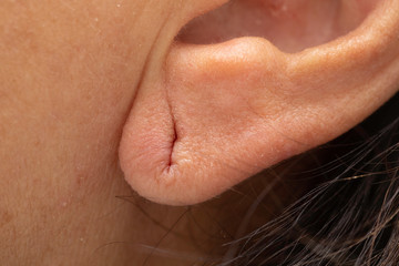 Earlobe with former piercing hole mark close up