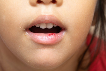 Obraz premium Injury, wound on child lip close up