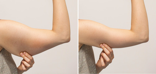 Flabby arm skin and slim hand comparison