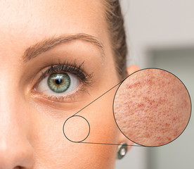 Woman face skin problems in zoom circle