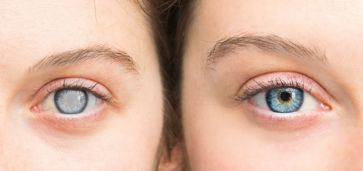 Person with white pupil and healthy eye comparison close up - obrazy, fototapety, plakaty