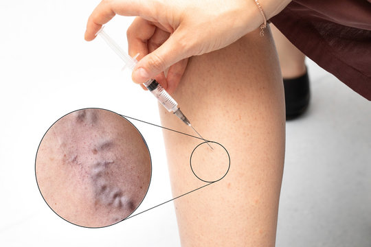 Woman making injection with syringe in leg skin with varicose vein close up