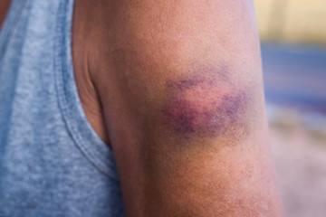 Contusion wound at left arm.