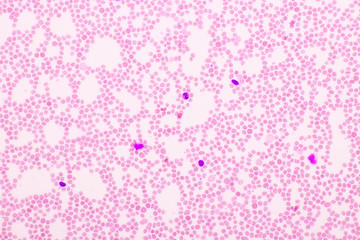 Picture of white blood cell, red blood cell and platelet in blood film