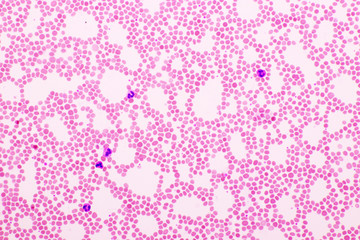 Picture of white blood cell, red blood cell and platelet in blood film