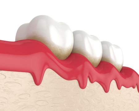3d Render Of Teeth In Bleeding Gums