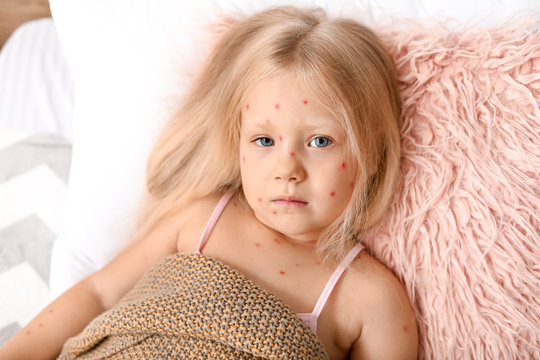 Little girl ill with chickenpox lying in bed