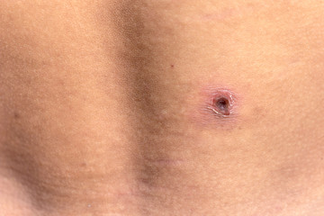 Fototapeta premium Wound infection on the skin. Skin ulcers of diabetic patients.