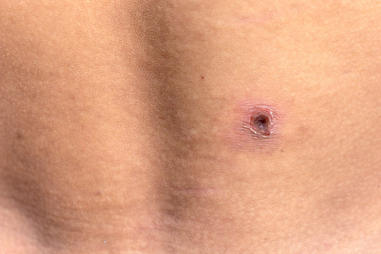 Wound infection on the skin. Skin ulcers of diabetic patients.