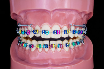 Close up  orthodontic model  - demonstration teeth model of varities of orthodontic bracket or brace