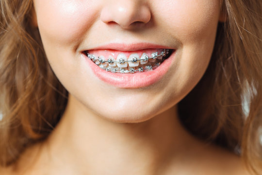 Orthodontic Treatment. Dental Care Concept. Beautiful Woman Healthy Smile close up. Closeup Ceramic and Metal Brackets on Teeth. Beautiful Female Smile with Braces.